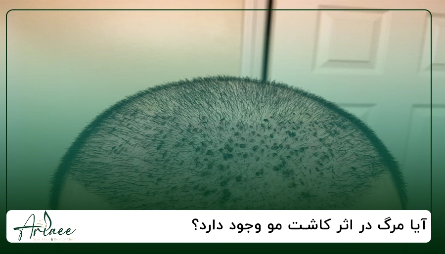 آیا مرگ در اثر کاشت مو وجود دارد؟