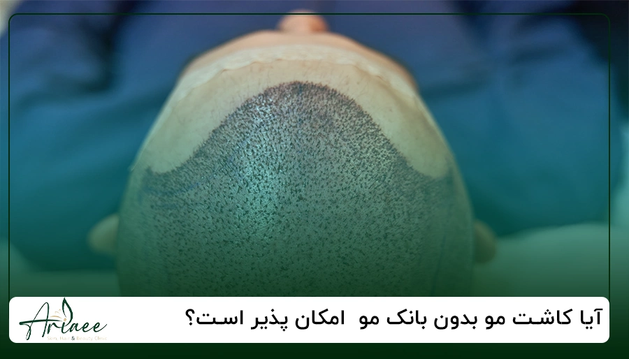 آیا کاشت مو بدون بانک مو امکان پذیر است؟