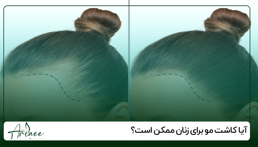 آیا کاشت مو برای زنان ممکن است؟