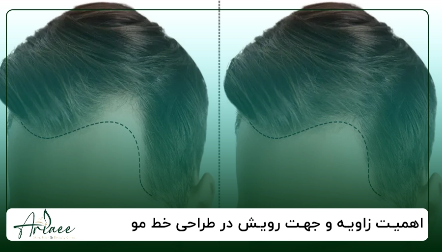 اهمیت زاویه و جهت رویش در طراحی خط مو