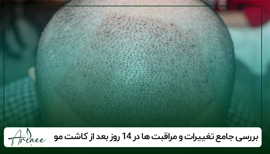 بررسی جامع تغییرات و مراقبت ها در ۱۴ روز بعد از کاشت مو