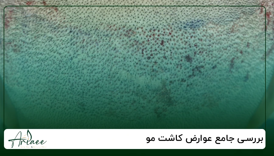 بررسی جامع عوارض کاشت مو