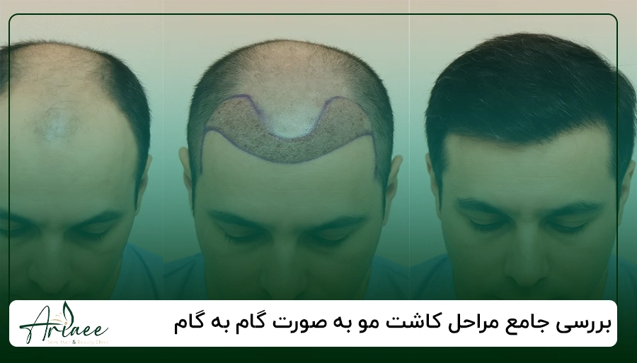 بررسی جامع مراحل کاشت مو به صورت گام به گام