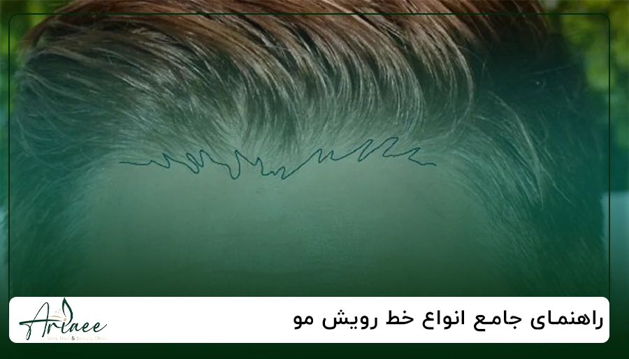 راهنمای جامع انواع خط رویش مو