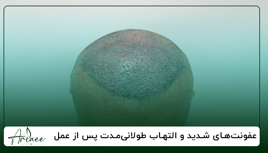 عفونت های شدید و التهاب طولانی مدت پس از عمل