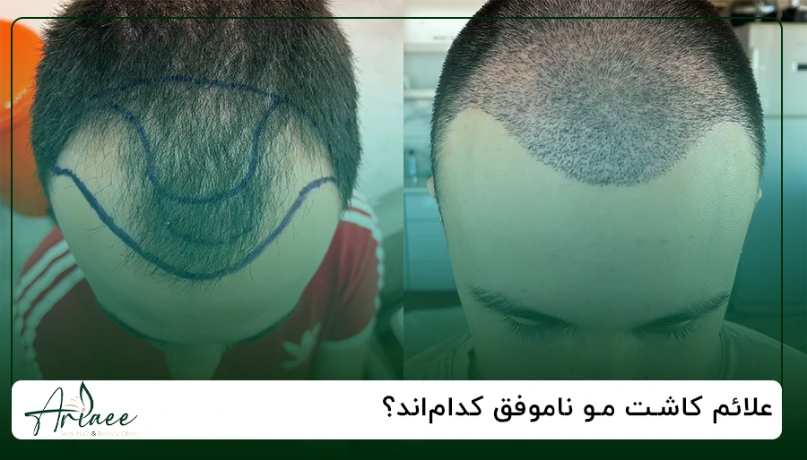 علائم کاشت مو ناموفق کدام_اند؟