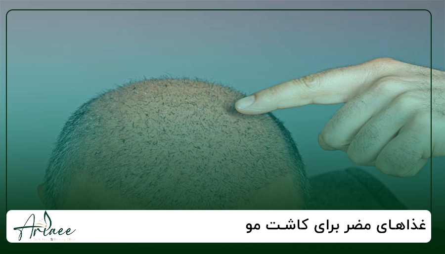 غذاهای مضر برای کاشت مو