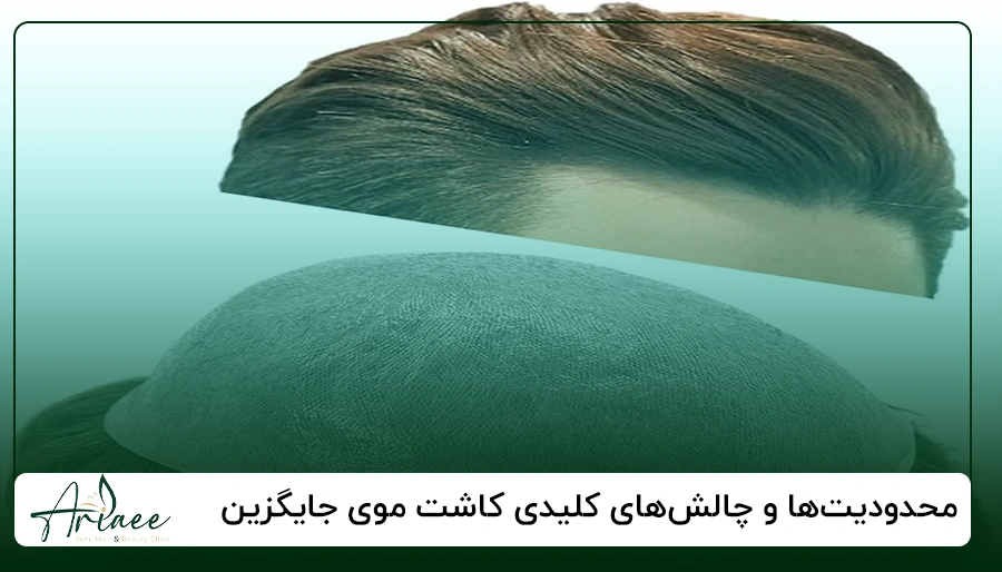 محدودیت ها و چالش های کلیدی کاشت موی جایگزین