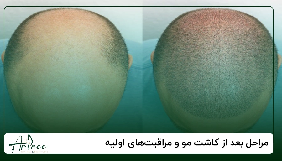 مراحل بعد از کاشت مو و مراقبت های اولیه