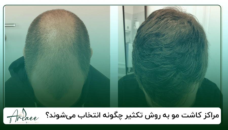 مراکز کاشت مو به روش تکثیر چگونه انتخاب می_شوند؟