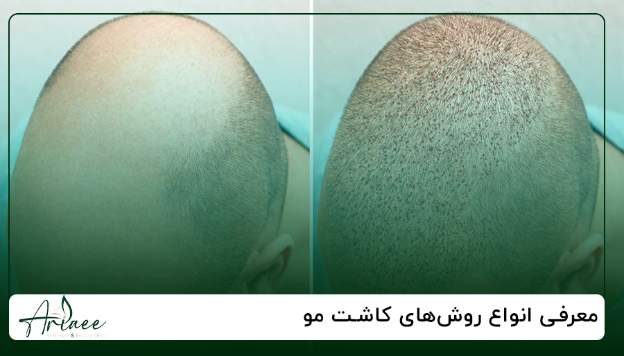 معرفی انواع روش های کاشت مو