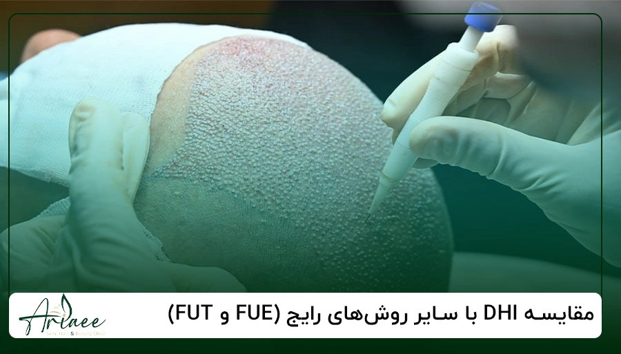 مقایسه DHI با سایر روش_های رایج (FUE و FUT)