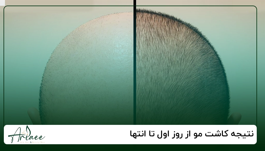 نتیجه کاشت مو از روز اول تا انتها