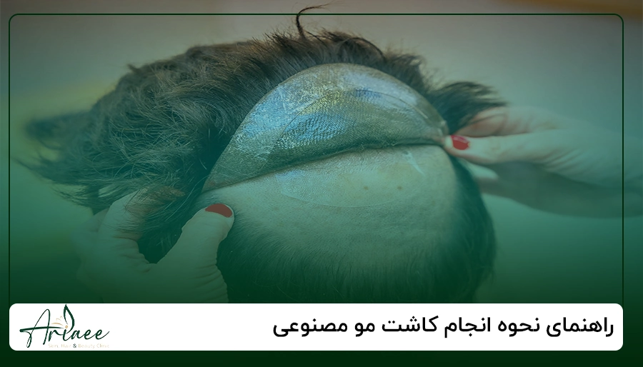 نحوه انجام کاشت مو مصنوعی