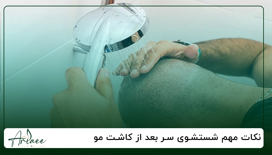 نکات مهم شستشوی سر بعد از کاشت مو