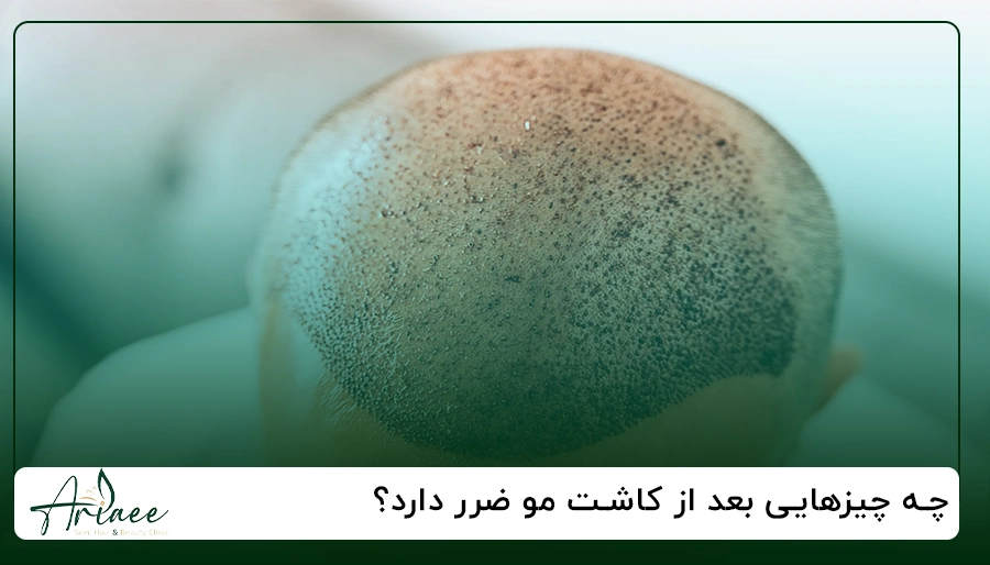 چه چیزهایی بعد از کاشت مو ضرر دارد؟