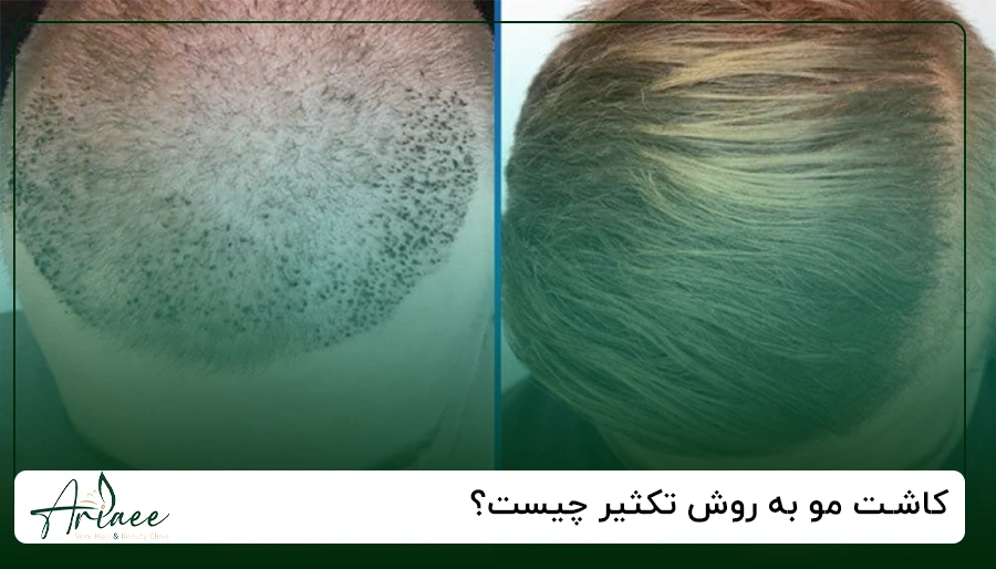 کاشت مو به روش تکثیر چیست؟