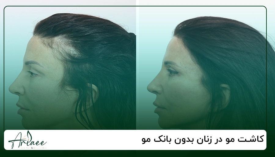 کاشت مو در زنان بدون بانک مو