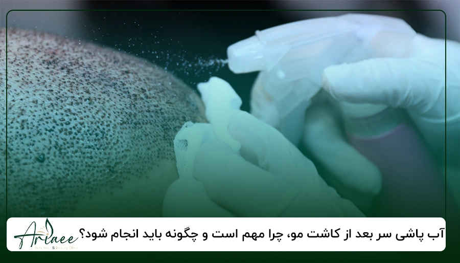 آب پاشی سر بعد از کاشت مو، چرا مهم است و چگونه باید انجام شود؟