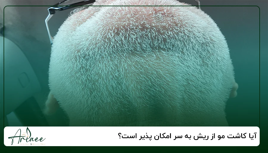 آیا کاشت مو از ریش به سر امکان پذیر است؟