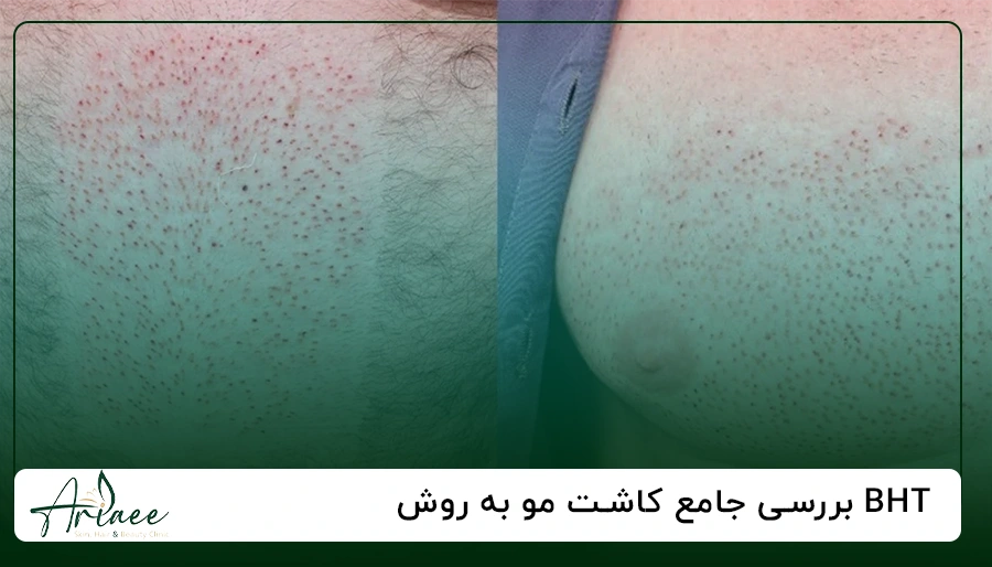 بررسی جامع کاشت مو به روش BHT