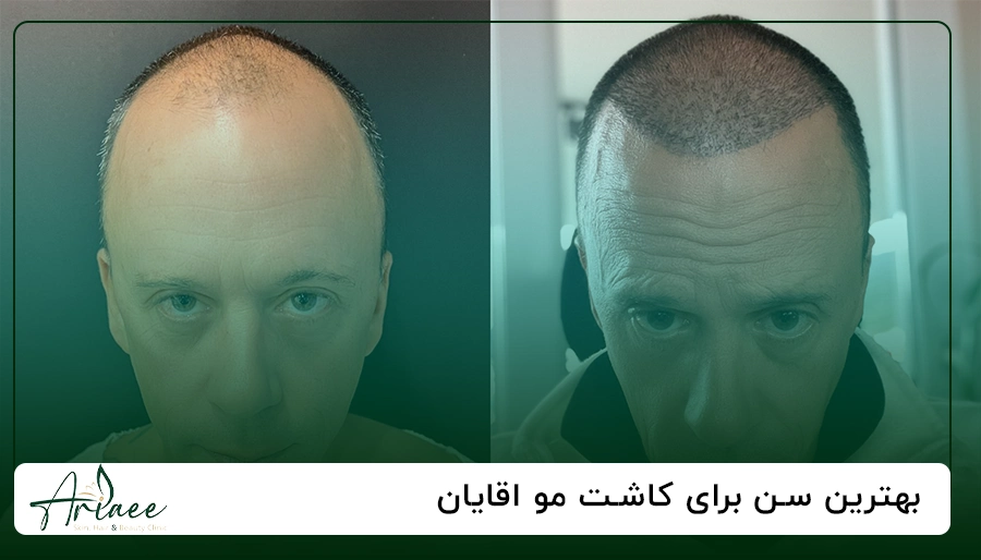 بهترین سن برای کاشت مو اقایان