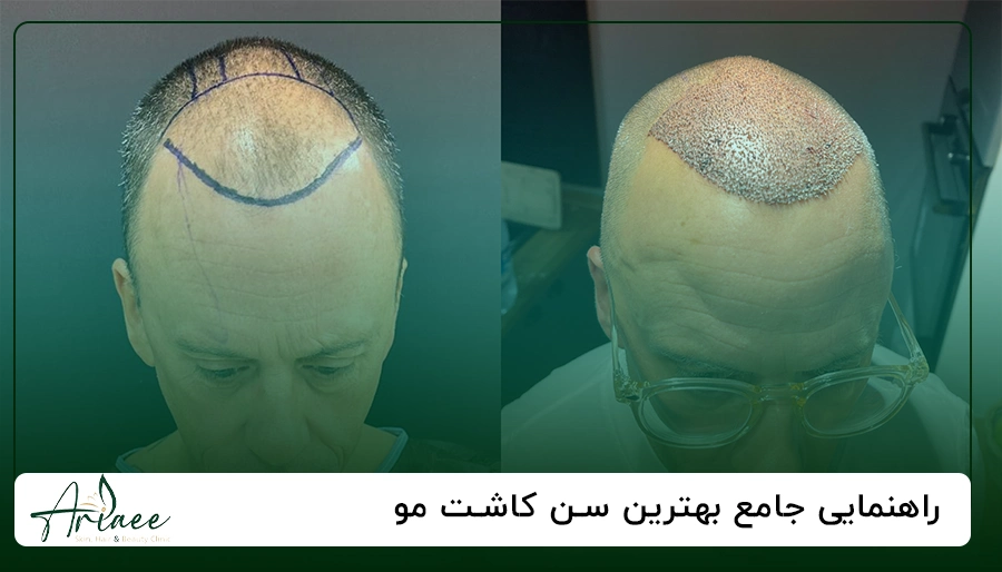 راهنمایی جامع بهترین سن کاشت مو