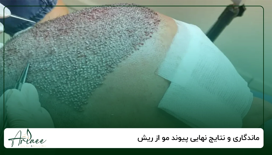 ماندگاری و نتایج نهایی پیوند مو از ریش