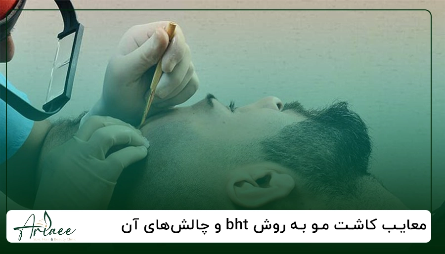 معایب کاشت مو به روش bht و چالش_های آن