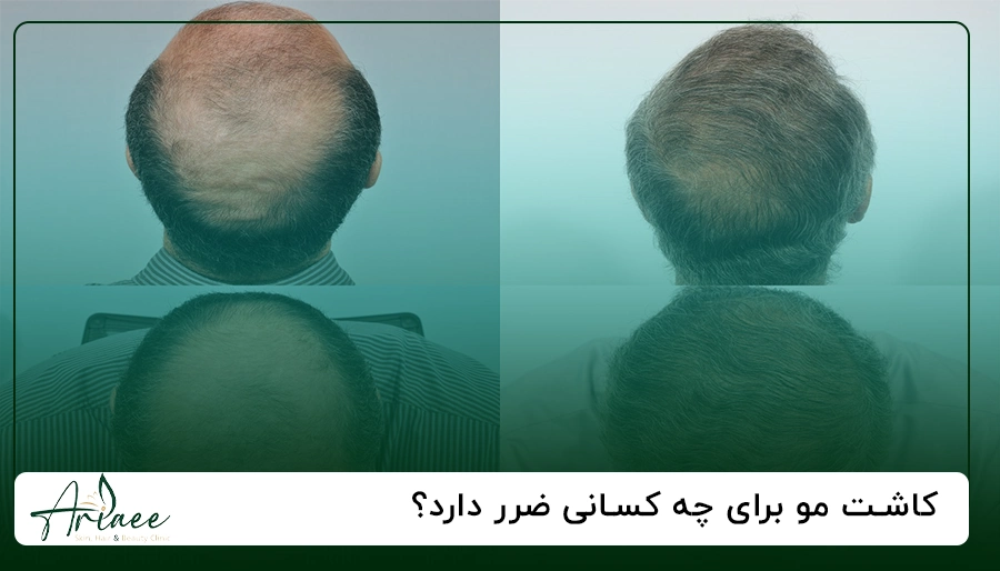 کاشت مو برای چه کسانی ضرر دارد؟