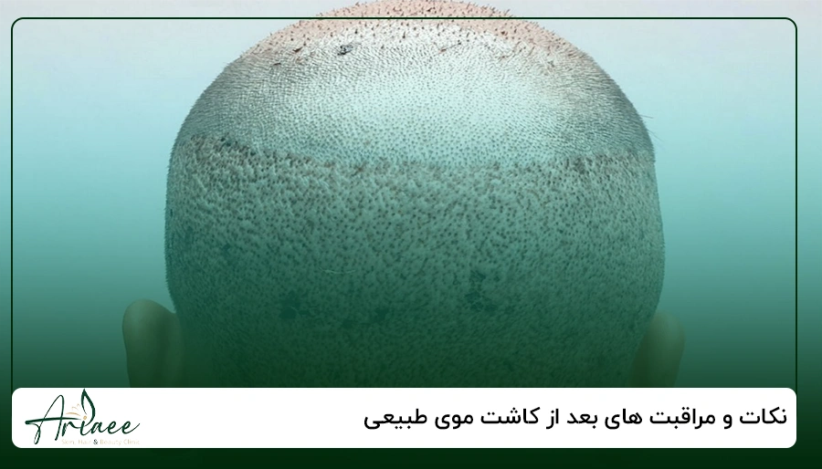 نکات و مراقبت های بعد از کاشت موی طبیعی