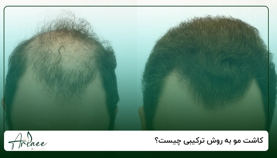 کاشت مو به روش ترکیبی چیست؟